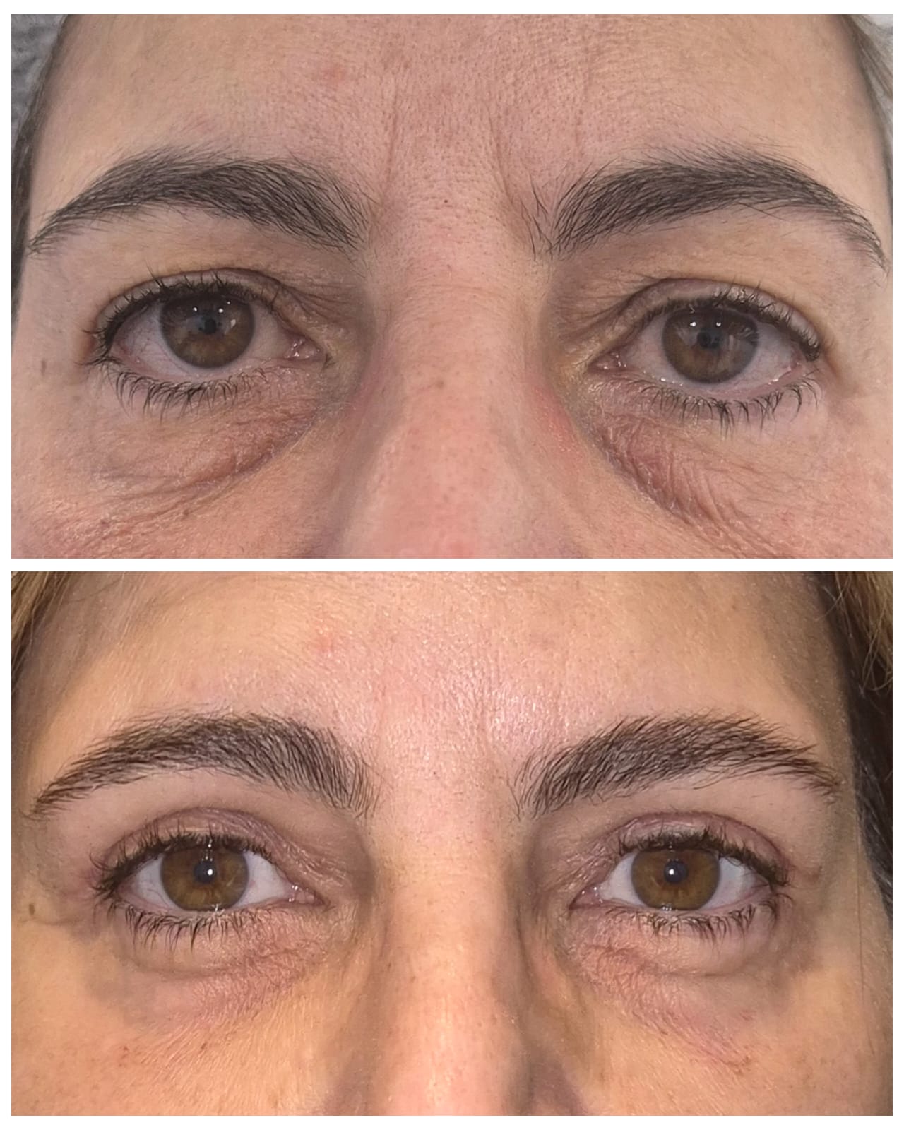 Detalhe da pálpebra superior antes e depois